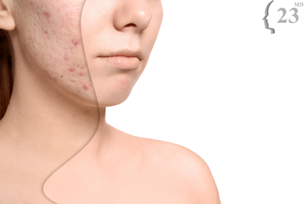 woman before and after acne scar treatment