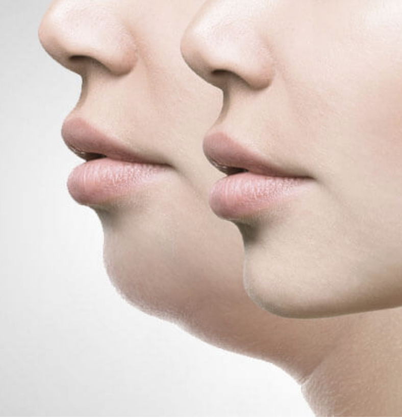 Dissolve Double Chins